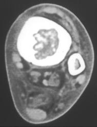 Sporotrichosis - CTisus CT Scan