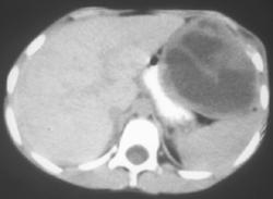 Ewing Sarcoma - CTisus CT Scan