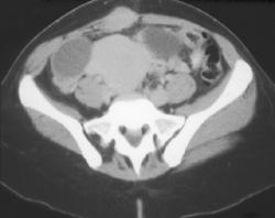 Endometrioma in Right Rectus Muscle - CTisus CT Scan