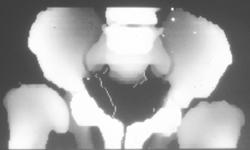 3D of the Pelvis- Circa 1982 (historical Moment) - CTisus CT Scan