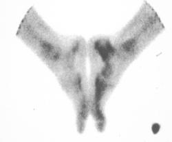 Melorriostosis - CTisus CT Scan