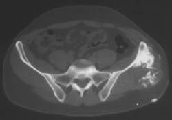 Chondrosarcoma - CTisus CT Scan