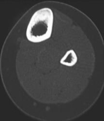 Osteoid Osteoma - CTisus CT Scan