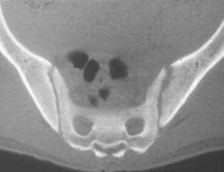 Sacroiliitis Due to Crohn's Disease - CTisus CT Scan