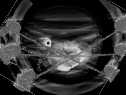 Tibial Fracture in Traction - CTisus CT Scan