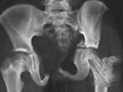 Hip Pinning for Fracture - CTisus CT Scan