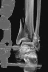 Spiral Tibial Fracture in Traction - CTisus CT Scan