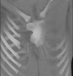 Congenital Deformed Sternum - CTisus CT Scan