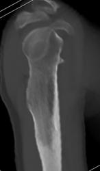 Exostosis Caused Shoulder Pain - CTisus CT Scan