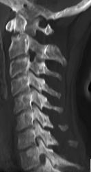 C-spine Trauma - CTisus CT Scan