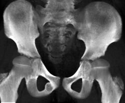 Benign Cyst in Inferior Pubic Ramus - CTisus CT Scan