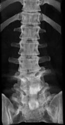 L-spine Fusion - CTisus CT Scan