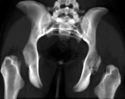 Posterior Acetabular Fracture and Sacral Fracture - CTisus CT Scan