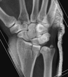 Radius and Ulna Fracture - CTisus CT Scan