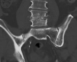 Osteomyelitis L4-5 - CTisus CT Scan