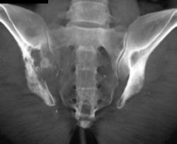 Metastatic Renal Cell Carcinoma - CTisus CT Scan