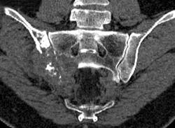 Metastatic Renal Cell Carcinoma - CTisus CT Scan