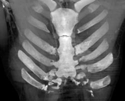 Fused Ribs to Cartilage in Too Early Pectus Repair - CTisus CT Scan