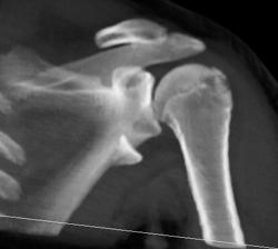 Glenoid and Humerus Fractures - CTisus CT Scan