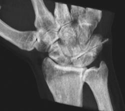 Pin in Scapula for Scaphoid Fracture - CTisus CT Scan