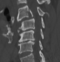 C-spine Fracture in 3D - CTisus CT Scan