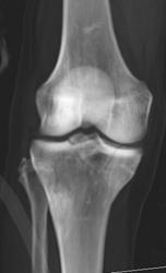 Tibial Plateau Fracture - CTisus CT Scan