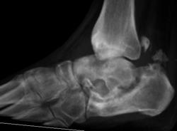 Charcots Joint - CTisus CT Scan