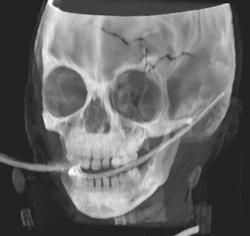 3D Skull Fracture - CTisus CT Scan