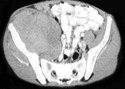 Ewing Sarcoma - CTisus CT Scan