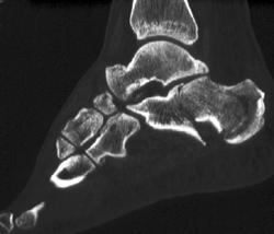 Calcaneal Fracture - CTisus CT Scan