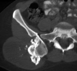 Chondrosarcoma Arising in Exostosis - CTisus CT Scan