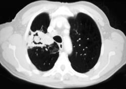 Lung Cancer With Bone Metastases - CTisus CT Scan