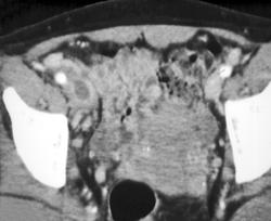 Needle Fragments in Right Groin With Deep Vein Thrombosis (DVT) - Intravenous Drug Abuse (IVDA) - CTisus CT Scan