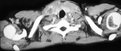 Fragments of Needles in Neck W/ Abscess - Intravenous Drug Abuse (IVDA) - CTisus CT Scan