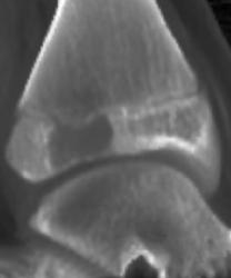 Chondroblastoma - CTisus CT Scan