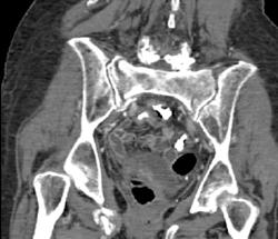 Stress Fracture - CTisus CT Scan