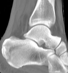 Calcaneal Fracture - CTisus CT Scan