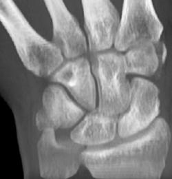 Scaphoid Fracture - CTisus CT Scan