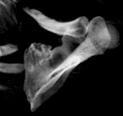 Exostosis - CTisus CT Scan