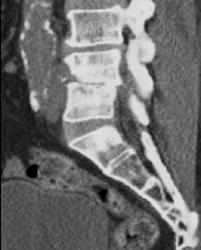 Unsuspected Osteomyelitis - CTisus CT Scan