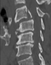 C-spine Fracture and Rotational Injury - CTisus CT Scan