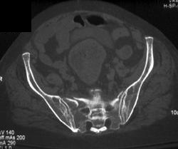 Sacral Stress Fracture - CTisus CT Scan