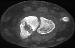 Non-union Scaphoid - CTisus CT Scan