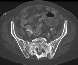 Stress Fracture - CTisus CT Scan