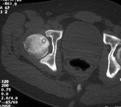 Osteoid Osteoma - CTisus CT Scan