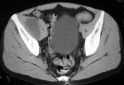 Psoas Abscess - CTisus CT Scan