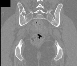 Hemangioma Right Iliac Bone - CTisus CT Scan