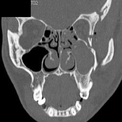 Orbital Fracture - CTisus CT Scan