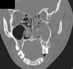 Orbital Fracture - CTisus CT Scan