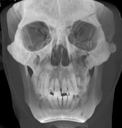 Orbital Fracture in 3D - CTisus CT Scan